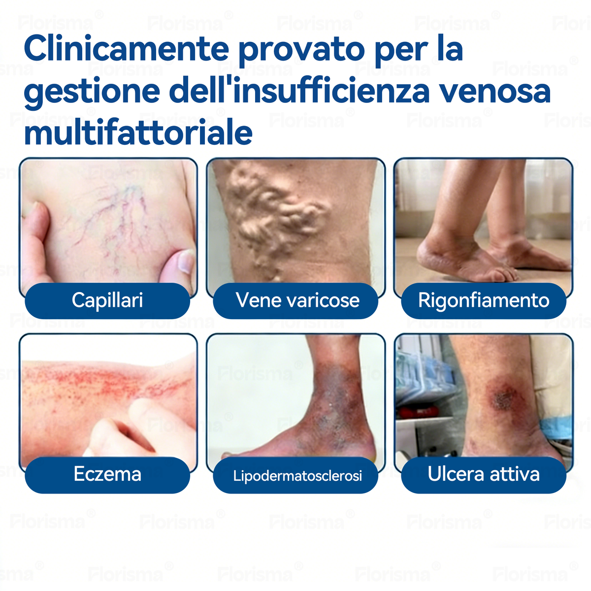 🛡️ 𝑭𝑳𝑶𝑹𝑰𝑺𝑴𝑨® 🎉 Cerotto Microneedle di Grado Clinico (con Diosmina ed Esperidina) — Progettato specificamente per contrastare i capillari visibili e le vene varicose, aiutando al contempo ad alleviare la sensazione di gambe pesanti e affaticate. 👩‍⚕️